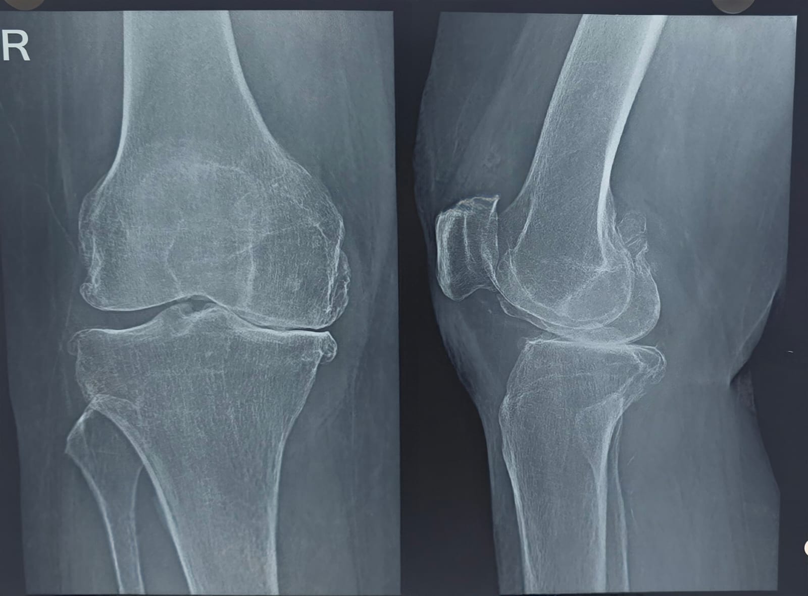 Before knee replacement X-ray showing arthritic joint